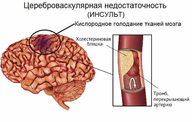 Ограничение мозговых клеток от попадания в них кислорода