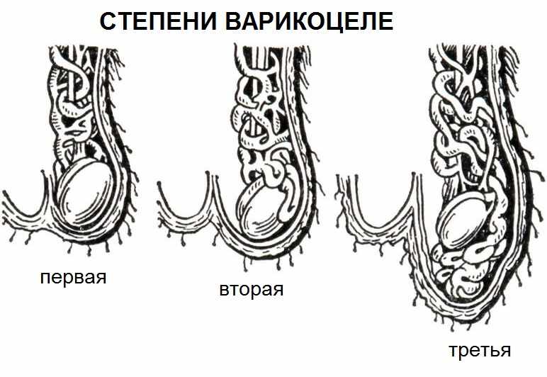 Степени развития варикоза яичек у мужчин