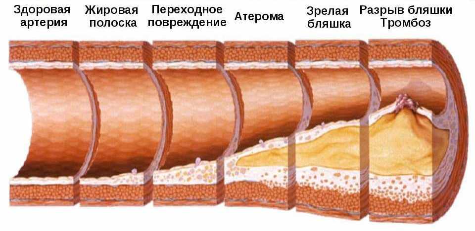 Стадии атеросклероза