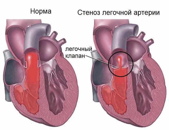 Порок сердца