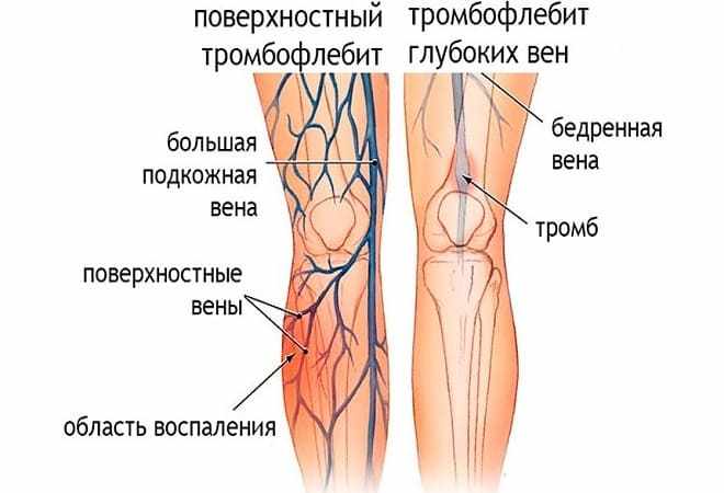 Посттромбофлебитический синдром