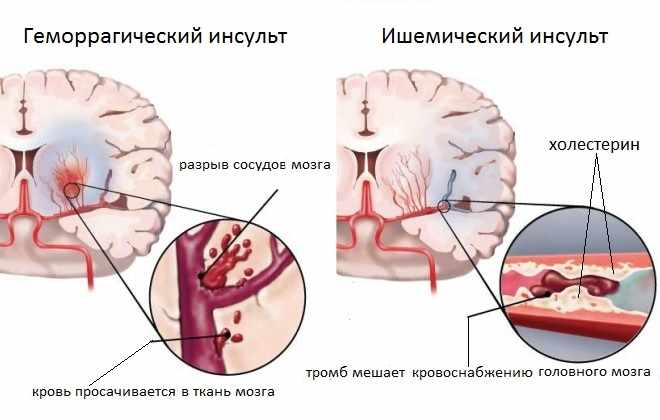 Два полушарья головного мозга с разными видами инсультов