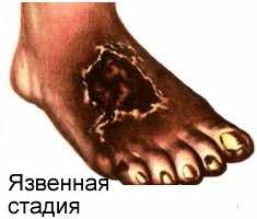 Язвенная стадия