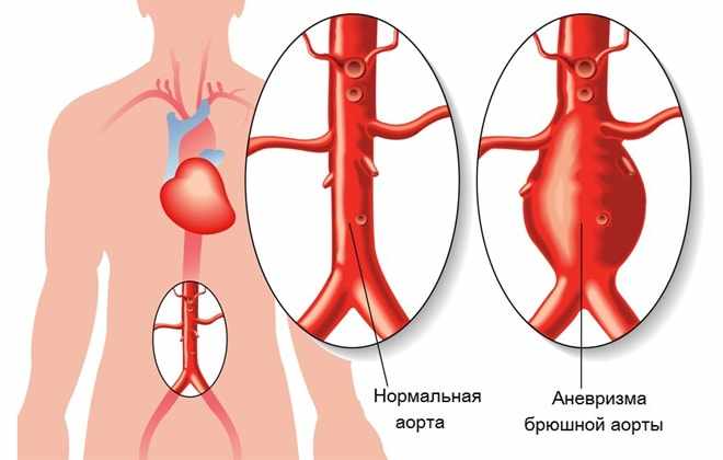Тромб в одинцовской аорте