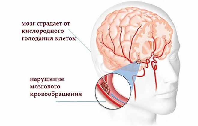 Дисциркуляторная энцефалопатия