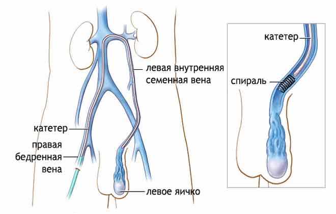 Эмболизация при варикоцеле