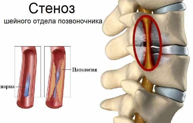 Заболевание кровеносной системы в области шеи