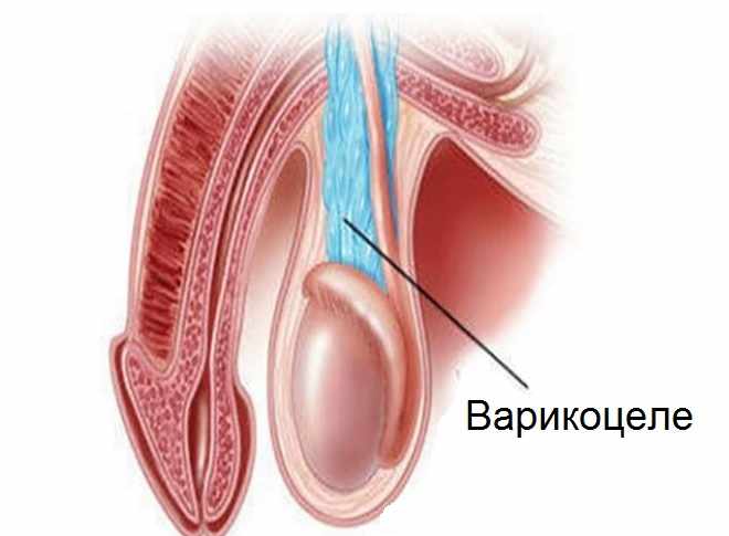 Увеличение вены левого яичка у детей