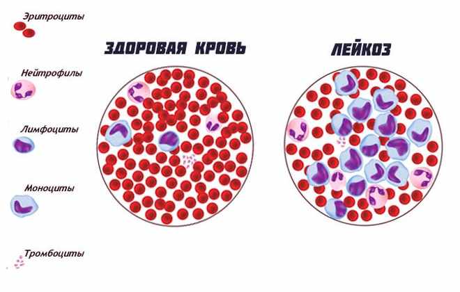 Разница крови здорового человека и заболевшего лейкозом