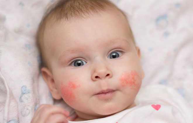 Алергия у ребенка