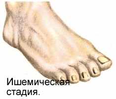 Ишемическая стадия