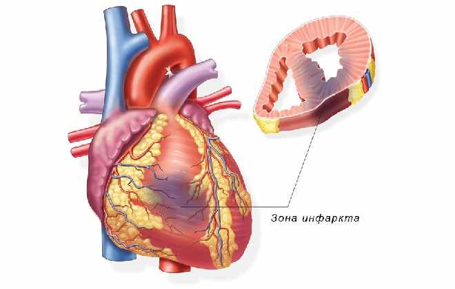 Зона инфаркта миокарда