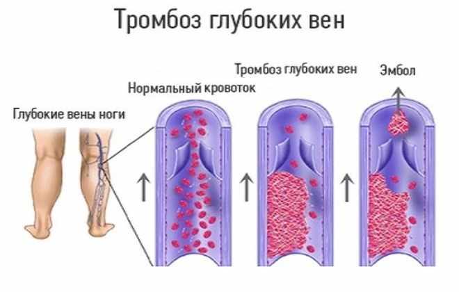 Тромбофлебит