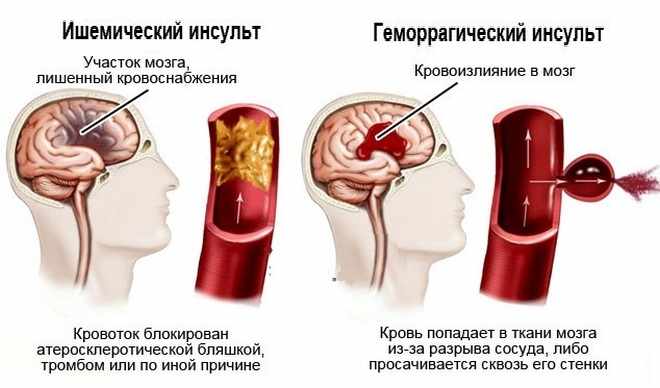 Причины по видам инсульта