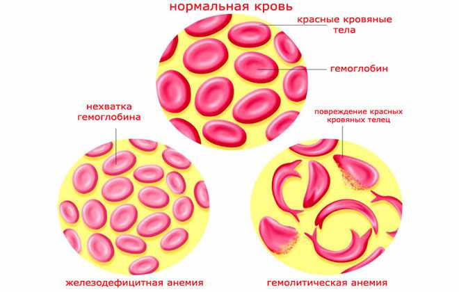 Гемолитическая анемия
