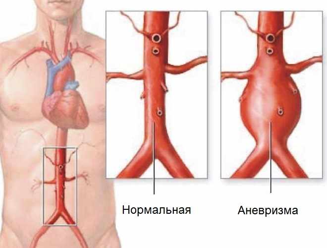 Увеличение брюшной аорты
