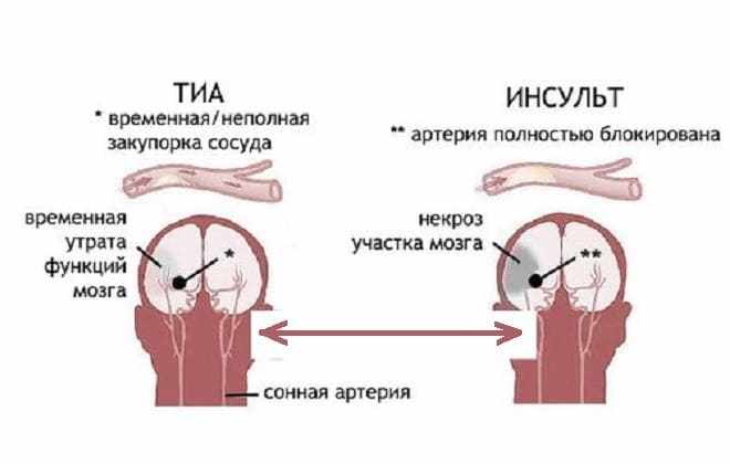 Сравнение транзиторной атаки с инсультом