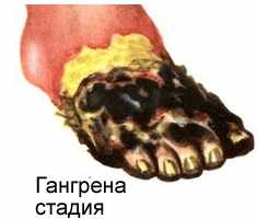 Стадия гангрены