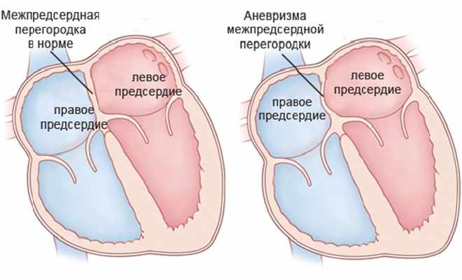 Проявление аневризмы в сердечной перегородке