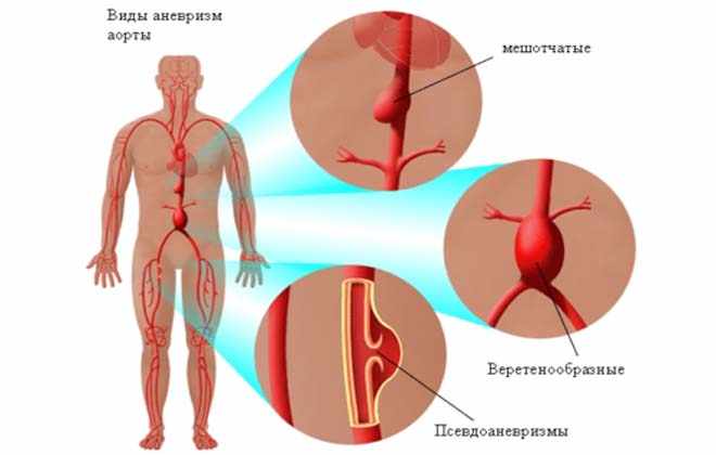 Артерия в бедре