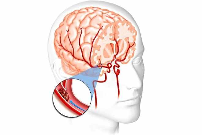 Сгусток крови в сосудах головного мозга