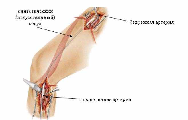 Лечение аневризмы бедренной артерии