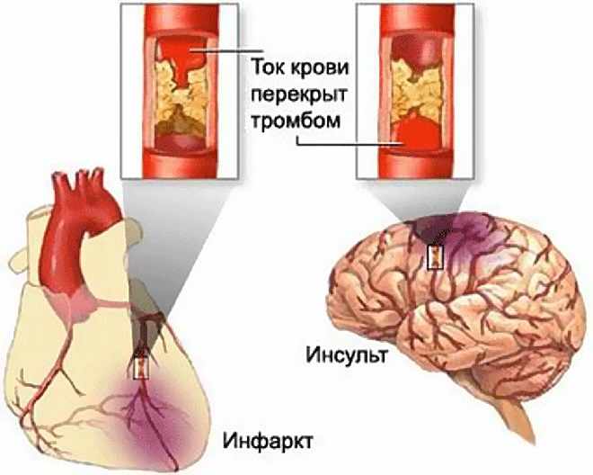 Разные места закупорки сосудов приводящие к летальным исходам