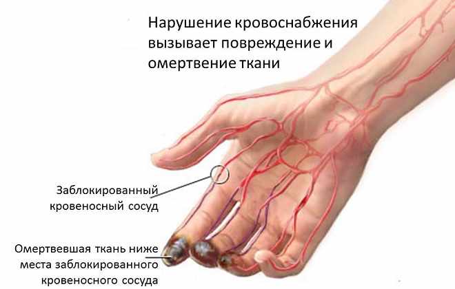 Системное иммунопатологическое воспалительное заболевание артерий