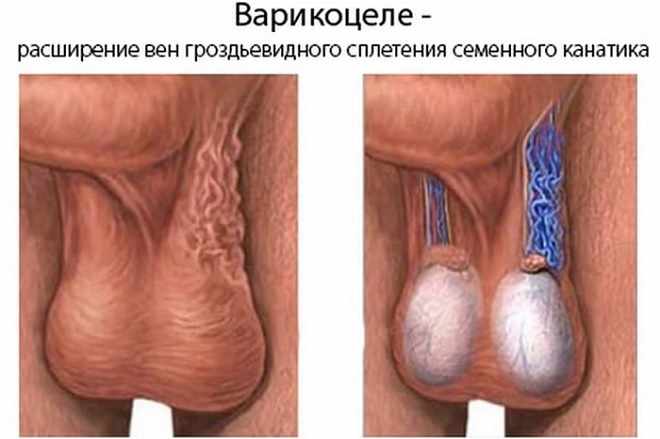 Расширение вен возле яичников у мужчин
